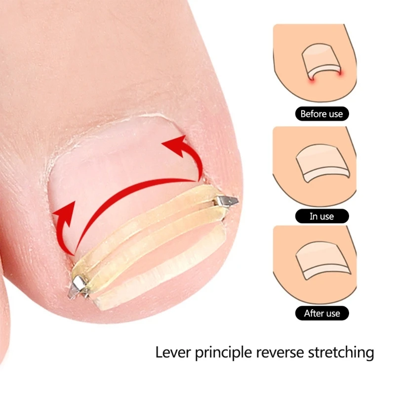 Levantador uñas encarnadas, Corrector uñas encarnadas, herramienta pedicura acero inoxidable, envío directo