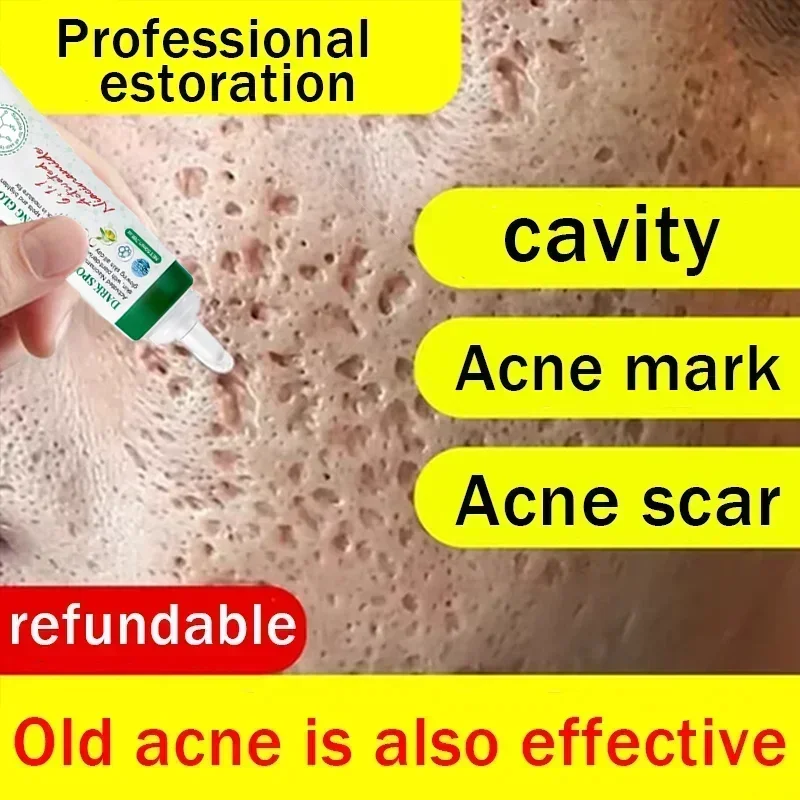 Anti-acne marca pothole reparação creme de reparação de buraco masculino desvanece-se para remover marca de acne cicatriz desbotamento preenchimento gel de regeneração