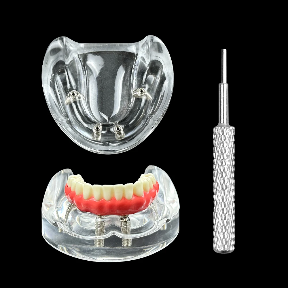 

Dental Typodont Teeth Study Implant Model Lower Jaw 4/6 Implants Overdenture Restoration for Researching Medical Dentist Study