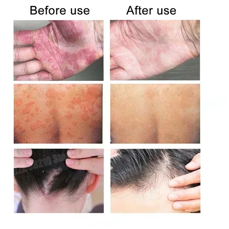 Рисунок 6 - Сверхсиловой крем от псориаза для