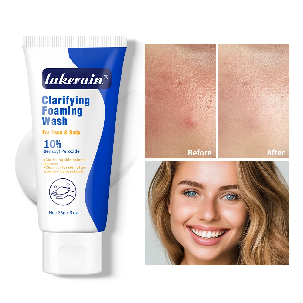 10%Benzoyl Peroxide Soothing and moisturizing Deep-Cleaning & Clarifying Foaming Wash Cleanser 85g