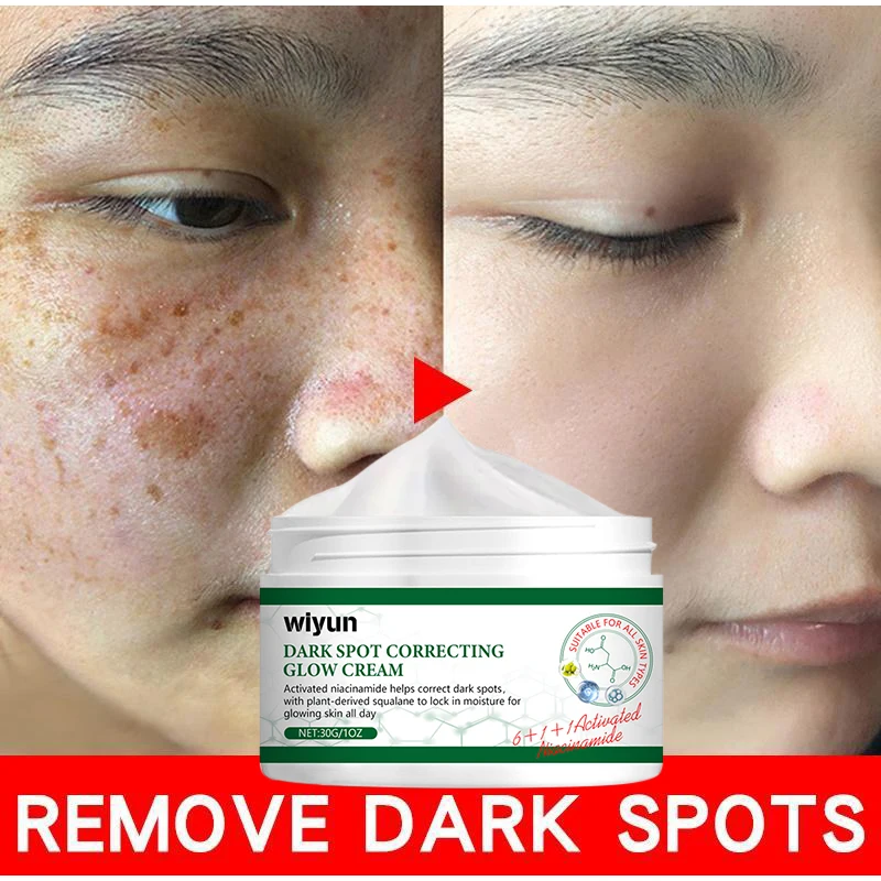 Hot Whitening Cream Powerful Freckle Effective Remove Melasma Melanin Corrector Anti-pigmentation Dark Spot Fade Improve Skin