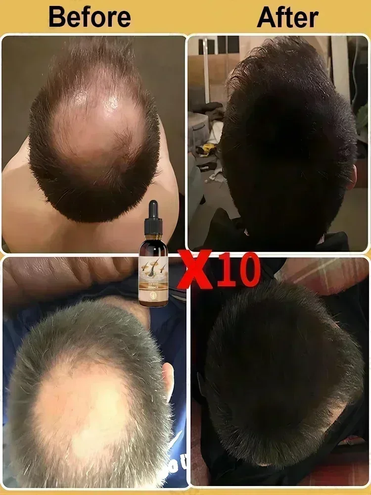 2024 Aceite para el crecimiento rápido del cabello Suero para el crecimiento del cabello Líquido para el crecimiento del adelgazamiento Antipérdida de cabello