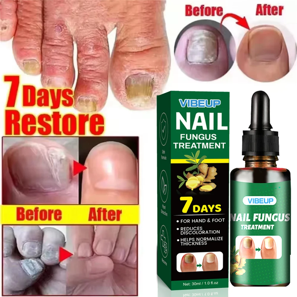 7일 곰팡이 발톱 치료 세럼 발톱 곰팡이 제거 복구 젤 항균 감염 발톱 주위염 발톱 진균증 발톱 관리
