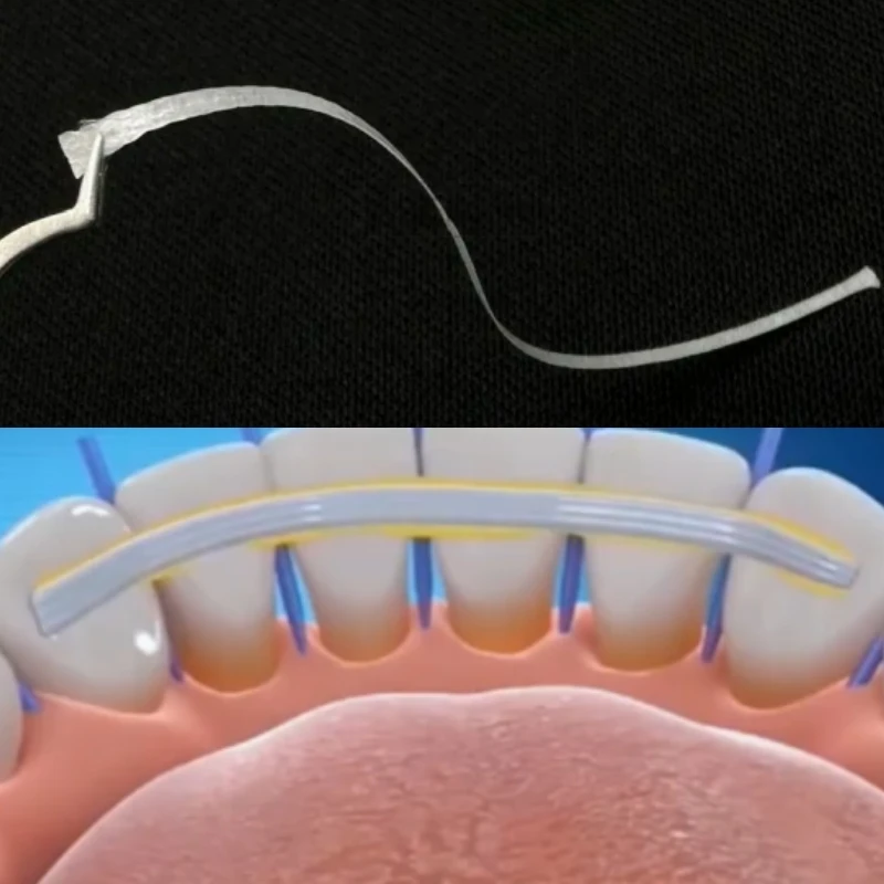 3Pcs Dental Flexible Fiber Strip Glass Splint Loose Tooth Fixation Strips Light Cure Bonding Orthodontic Retainers