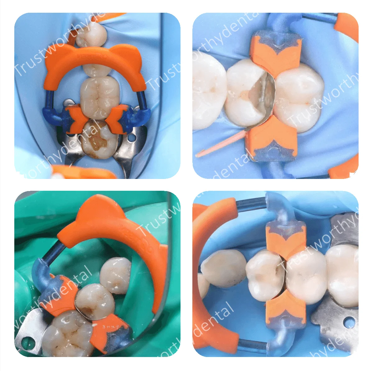 الأسنان مصفوفة حلقة ثلاثية الأبعاد التيتانيوم المشبك استعادة الأسنان المولي حلقة طويلة الكبار الاقسام مصفوفة المشابك التيتانيوم مع المطاط الناعم #3