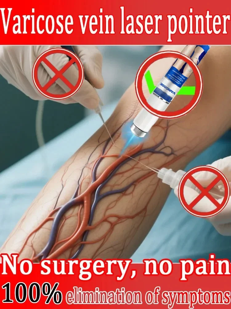 الجيل الثالث يزيل التهاب الأوعية الدموية والتهاب الوريد ويخفف آلام الساق العنكبوتية ومؤشر العلاج بالليزر للدوالي