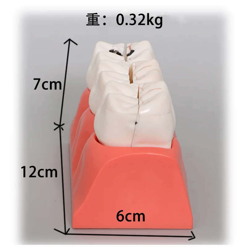 Modello di sviluppo delle carie dentali Modello dentale Modello di disintegrazione delle carie Multiplicazione quadrupla a 3 fasi
