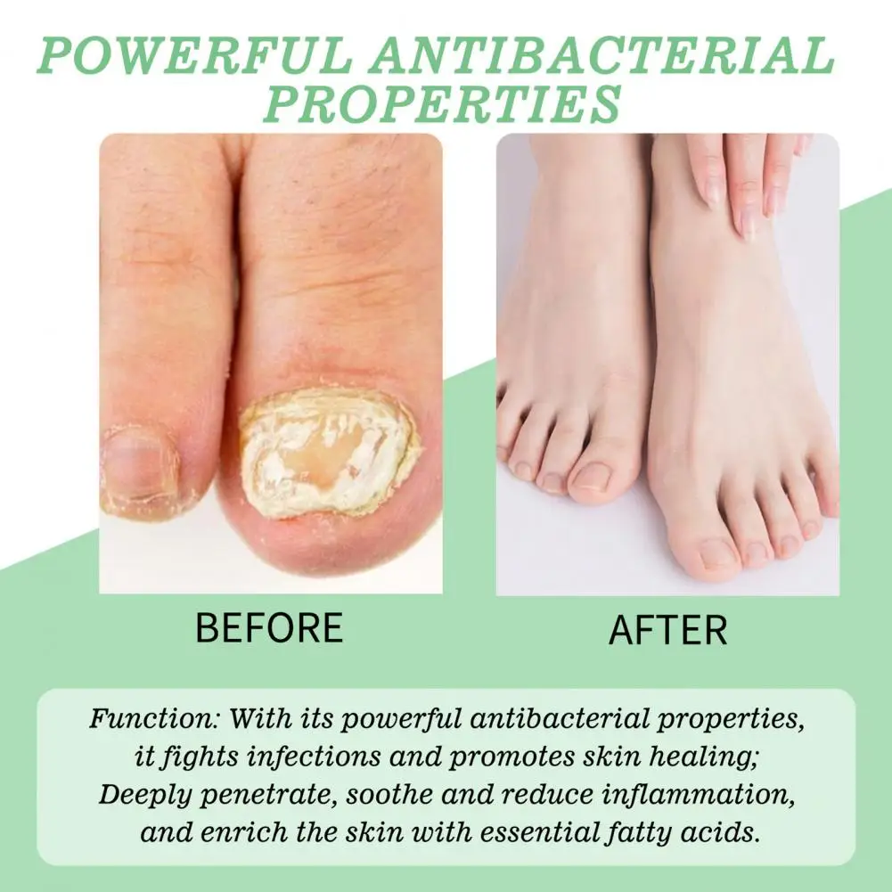 Nail Repair Gel Natural Nail Fungus Treatment Gel for Men Women Hydrating Moisturizing Repair Care Portable Multi-purpose