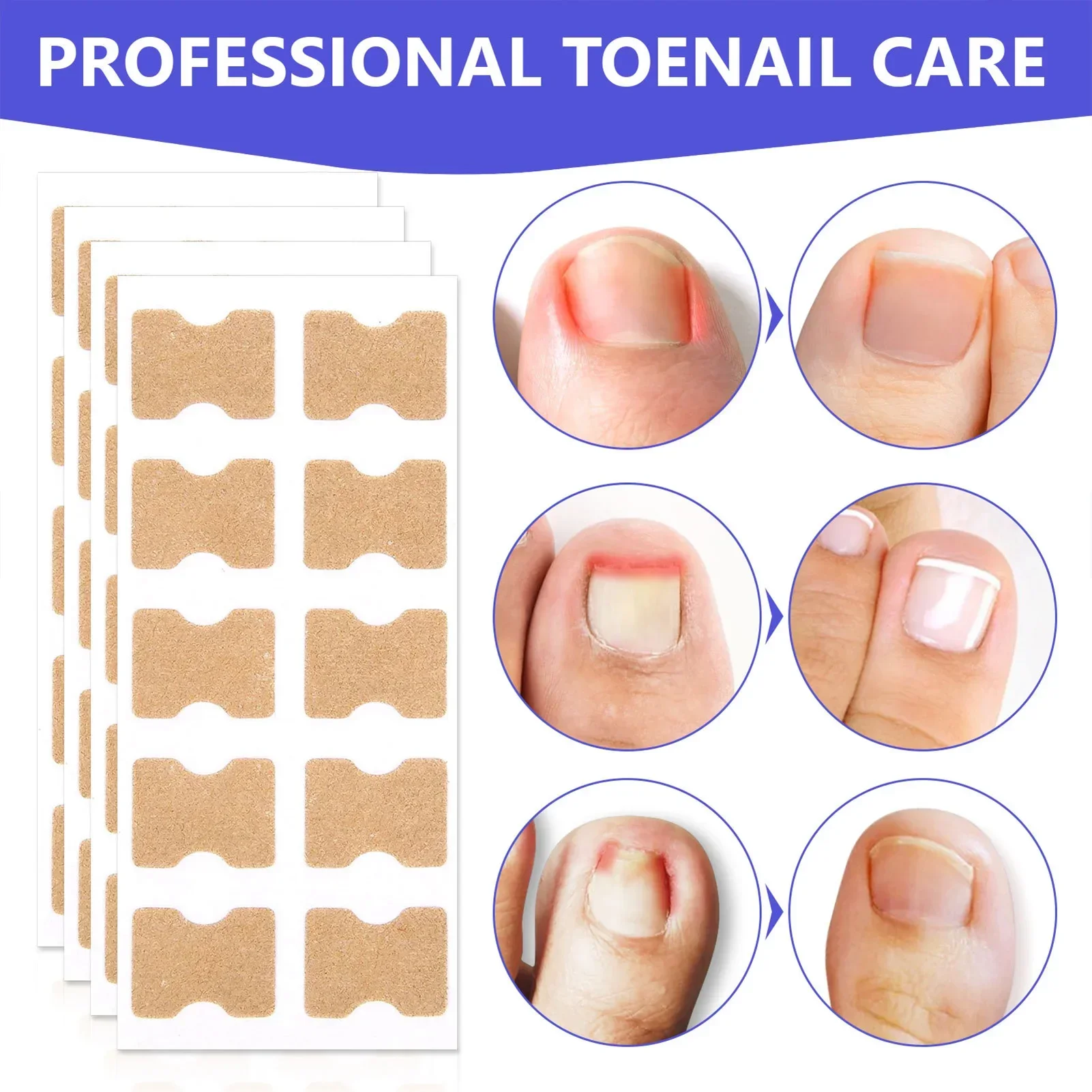 

300Pcs Toenail Corrector Patch Paronychia Treatment Fungus Removal Nail Ingrown Correction Stickers Nails Recover Pedicure Tools