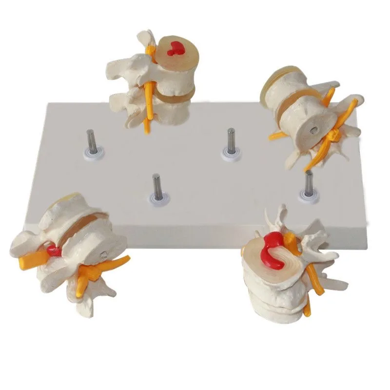 Lumbar Spine Structure Display Model Teaching Demonstration Accessory