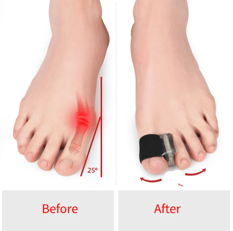 

2Pcs=1Pair Big Bone Thumb Toe Separator Bunion Splint Straightener Corrector Foot Care Tools Hallux Valgus Protector Orthotics