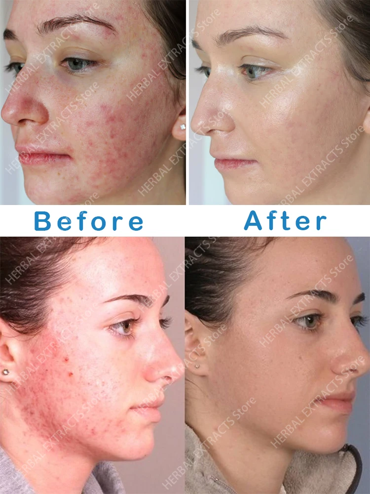 Acne Skin Care