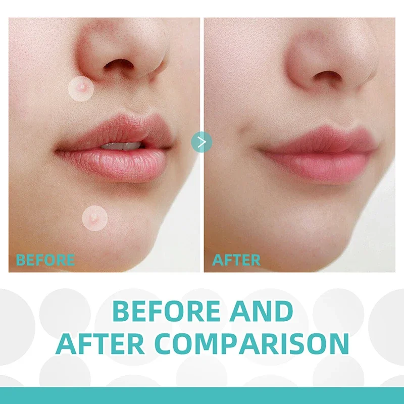 Adesivos faciais ferramentas de cuidados com a pele acne remendo reparação facial acne poros limpos hidratar e suave ferramentas de cuidados com a pele