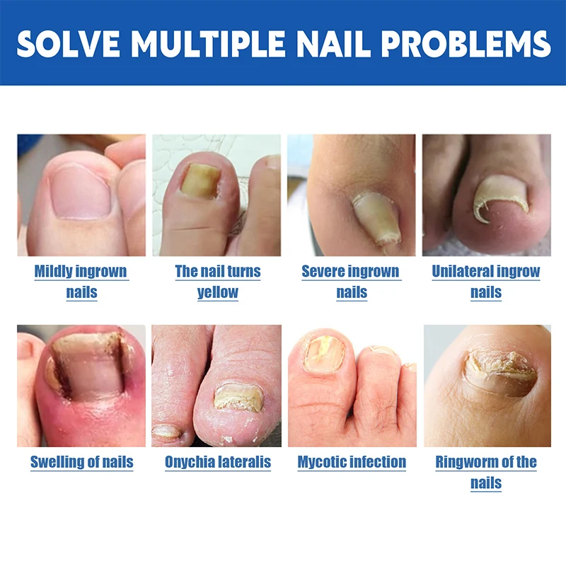 10ชิ้นสติกเกอร์แก้ไขเล็บเล็บเท้าคุด Onychomycosis ซ่อมแซมแพทช์ paronychia รักษากู้คืนเครื่องมือทำเล็บเท้า