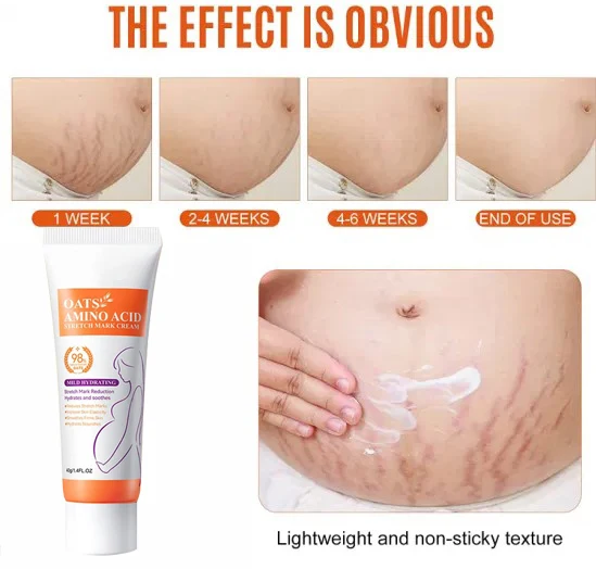 Eliminate Red White Old Stretch Marks Cream For Pregnancy Postpartum Skin Care Gel