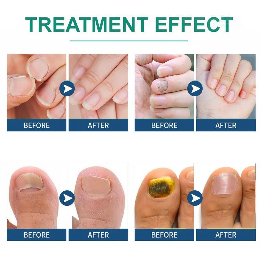Remendo de tratamento de paroníquia, remoção de fungos, adesivos de correção de unhas encravadas, recuperação de unhas, ferramenta de cuidados de pedicure, 1/2/3 pacotes