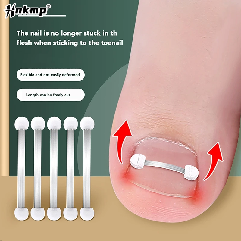 내성발톱 교정 도구, 내성발톱 치료, 탄성 패치 스티커, 스트레이트닝 클립 브레이스, 페디큐어 도구, 1 개