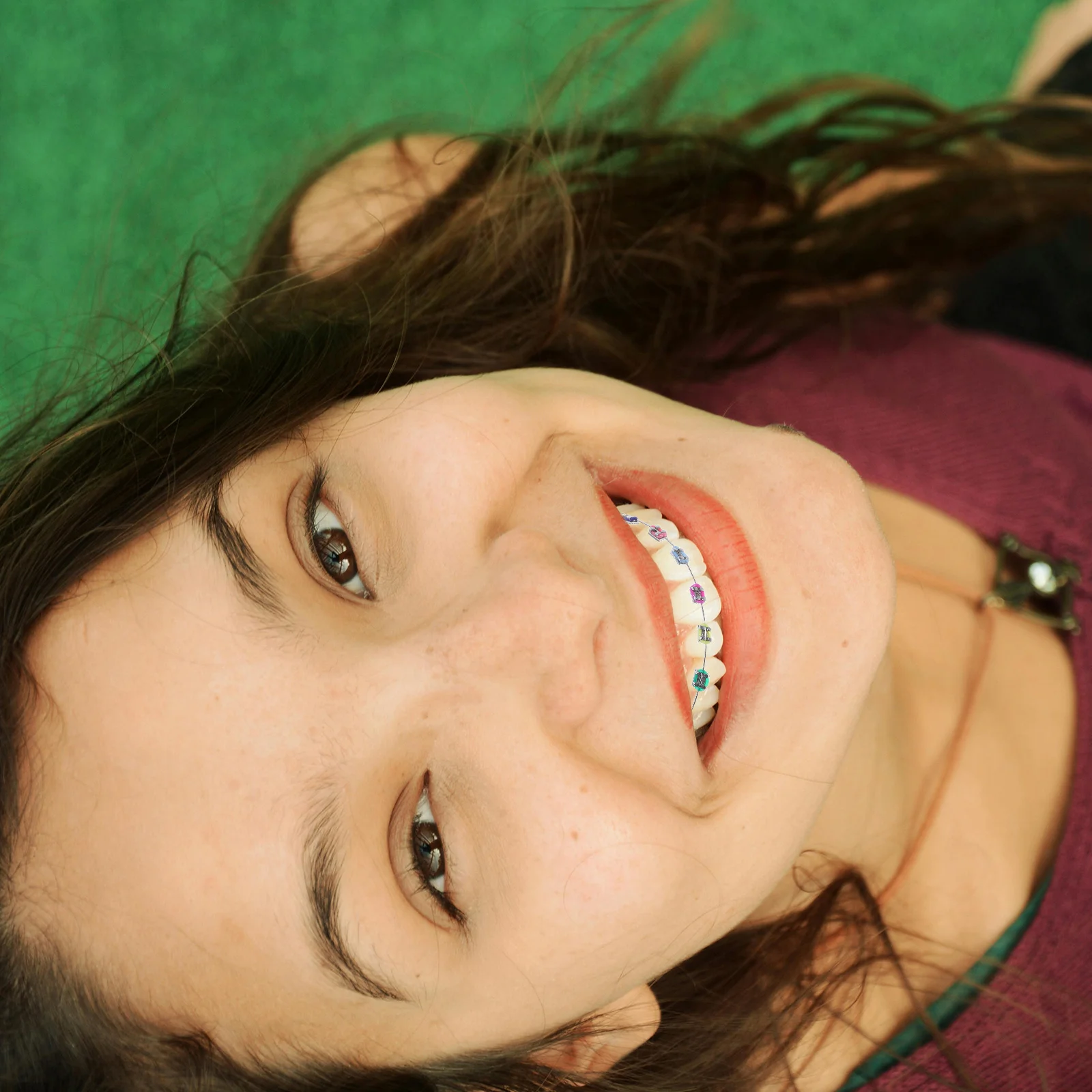 

Metal Bracket Straightening Tool For Crowded Misaligned Teeth Comfortable Fit Long Lasting Results Teeth Practice Props