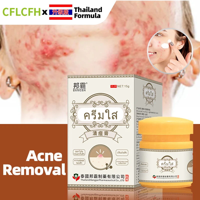 Acne Treatment Cream Anti Acne Marks Removal Pimple Ointment Face Care Blackhead Remover Shrink Pores Whitening Thailand Formula