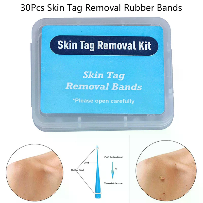 20pcs Skin Tag Removal Rubber Bands Micro Band Non Toxic Face Care Mole Wart Tools High-quality