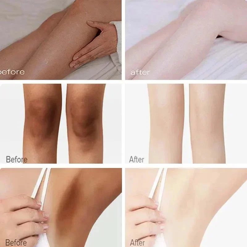 Crema sbiancante parti intime sbiancamento delle ascelle sbiancare il ginocchio del culo illuminare la coscia interna parti intime scuro rimuovere la cura della melanina