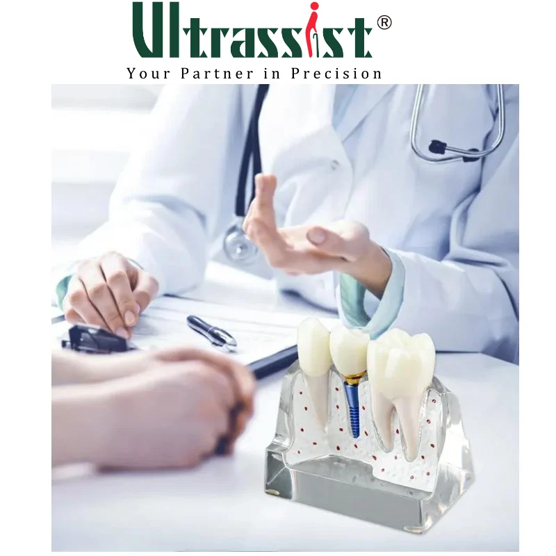 Ultrassist Dental Implant Model for Patient Education, 4 Times Dental Implant, Crown and Bridge Model for Presentation-Transpare