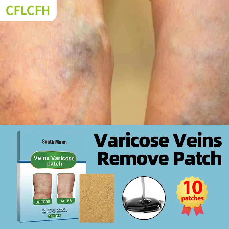 

Varicose Veins Relief Patch Foot Care Vasculitis Phlebitis Treatment Cream Spider Leg Varicosity Angiitis Legs Dilated Medicine