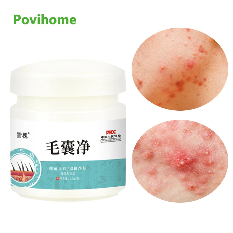 

20g Herbal Plaster Pain Relief Anti-Itching Antibacterial Cream Remove for Body Acne Folliculitis Itching Skin Care Ointment