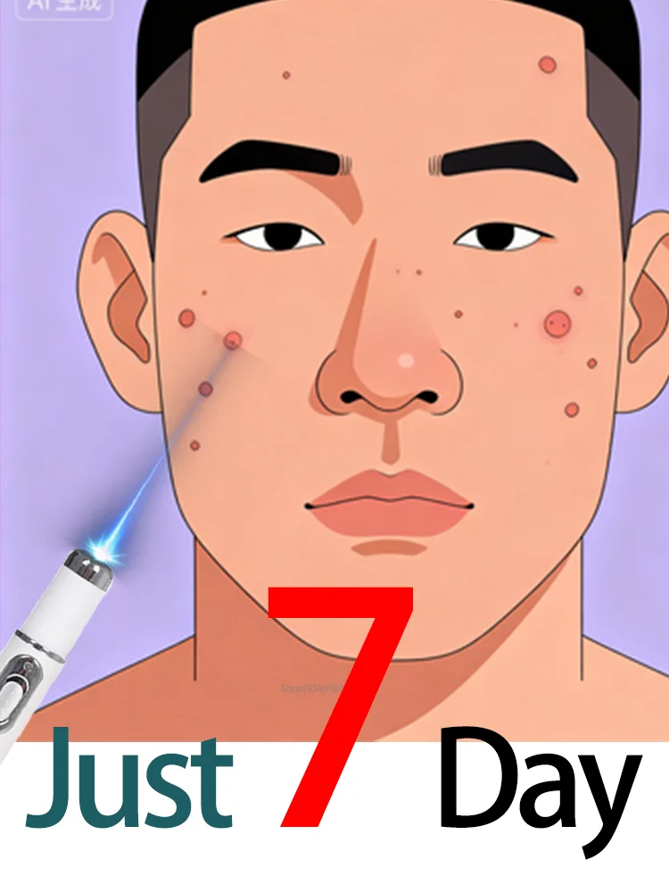 Urządzenie na brodawki z niebieskim światłem, większe zniżki na zestawy