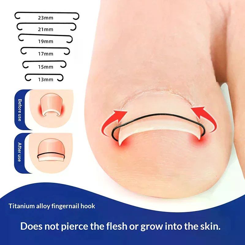 2Pcs Ingrown Toenai…