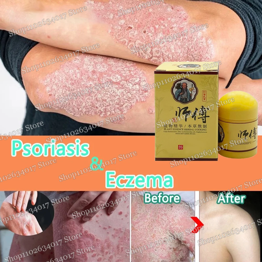 Psoriasis Antibacterial Anti-Itch Eczema Red Rash Urticaria Blister Desquamation Dermatitis Relief Cream