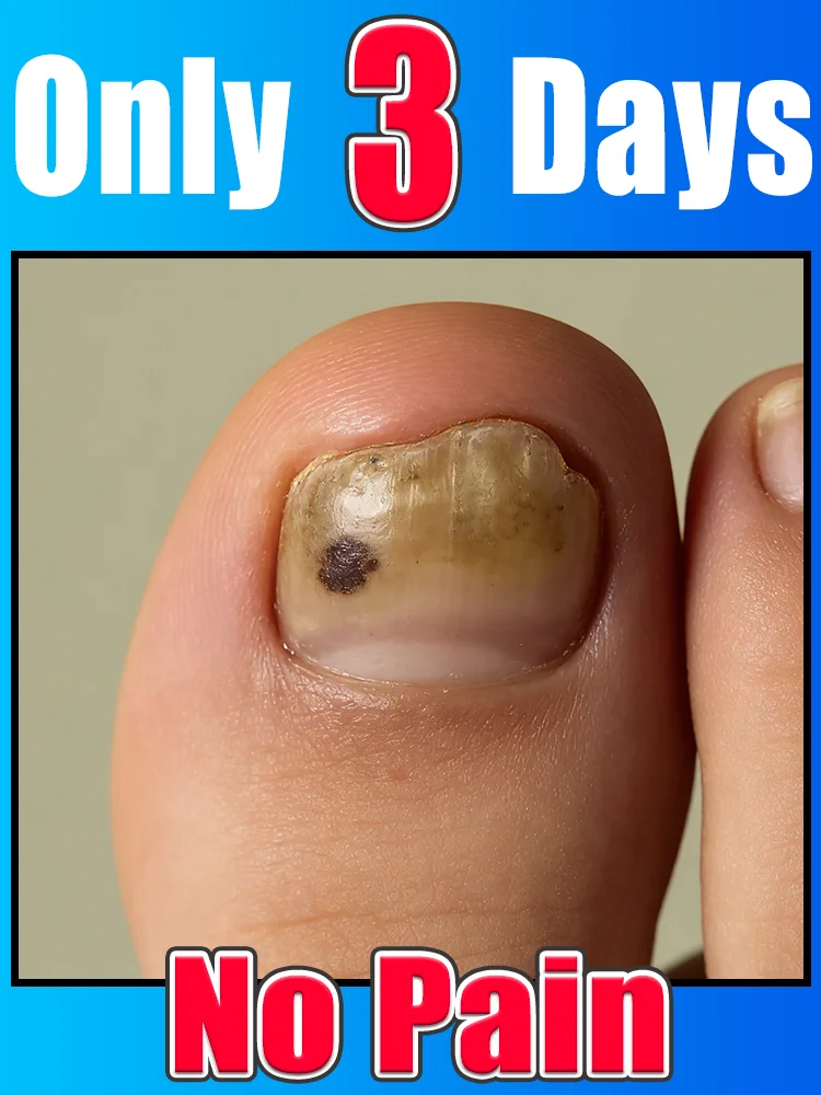 

Qᴜɪᴄᴋʟʏ ᴇʟɪᴍɪɴᴀᴛᴇ ғᴜɴɢᴜs ᴀɴᴅ ʀᴇsᴛᴏʀᴇ ʜᴇᴀʟᴛʜʏ ɴᴀɪʟs