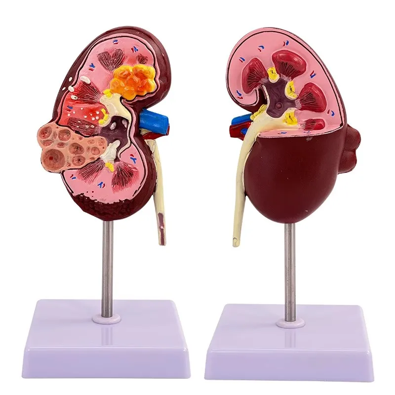 Kidney Pathologies Model Human Body Anatomy Replica of Diseased Kidney for Doctors Office Educational Tool