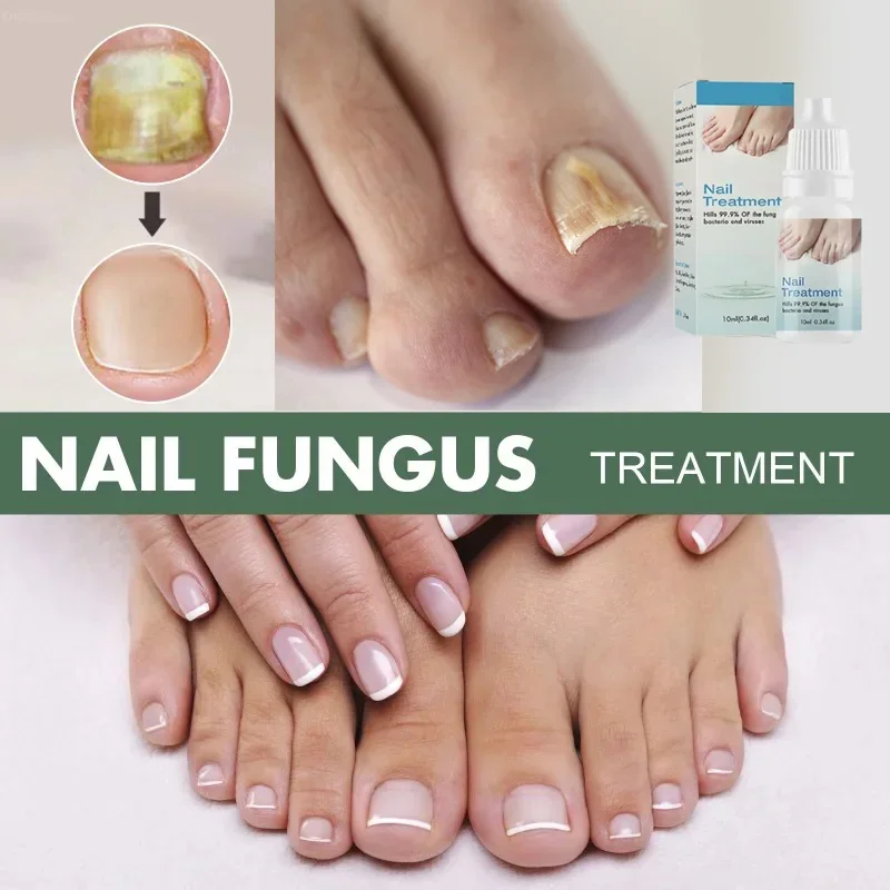 Toenail Nail Fungus Treatment Repair Fingernail Device Toenail Treatment for Foot Nail Fungus Essential Oil Onychomycosis Care