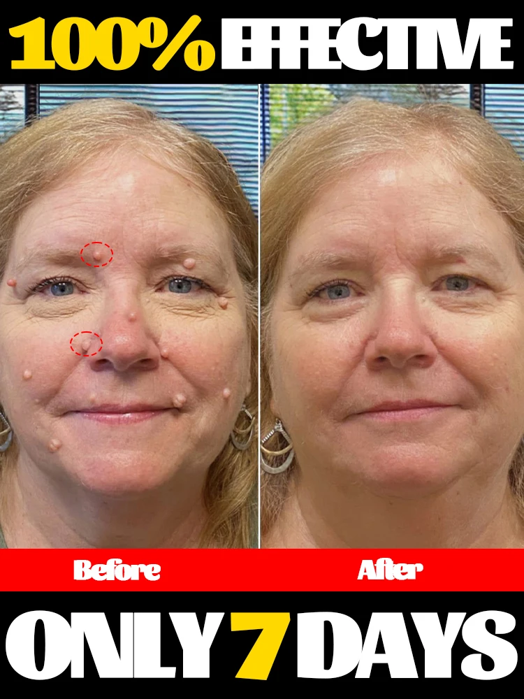 

Bestselling ᵇˡᵘᵉ ˡⁱᵍʰᵗ ᵖᵉⁿ ᶠᵒʳ ʷᵃʳᵗ ʳᵉᵐᵒᵛᵃ and treatment, latest 2025 model