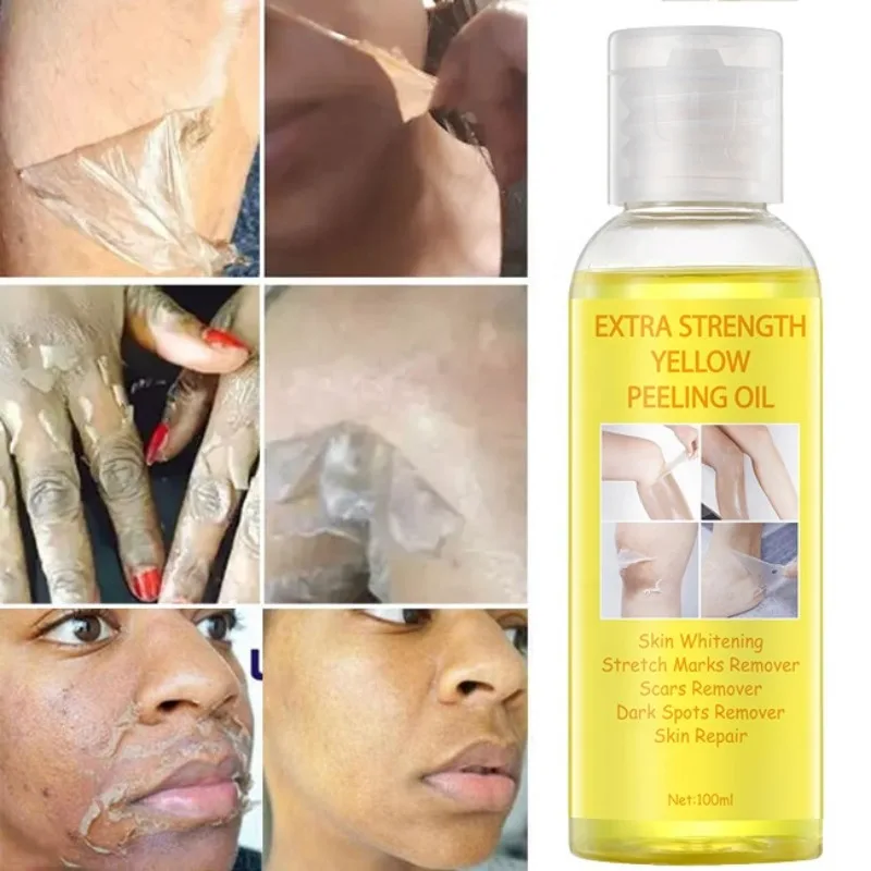 Óleo de Peeling Amarelo Super Força para Pele Negra, óleo clareador forte, removedor de pele, óleo de peeling amarelo clareador africano