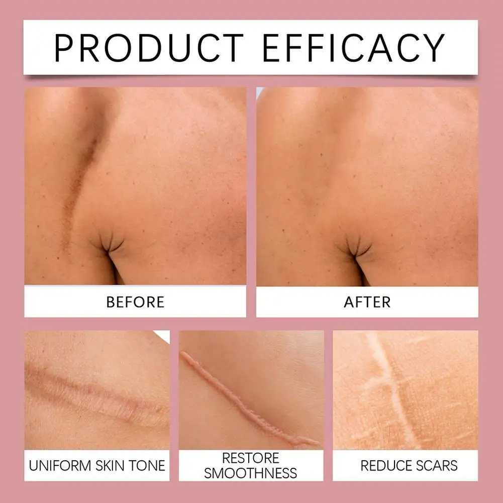 

Hot Hydrocolloid Patch Bandages Hydrocolloid Bandage Roll For Wound Care Waterproof Self-Adhesive For Face Body Burn Wound