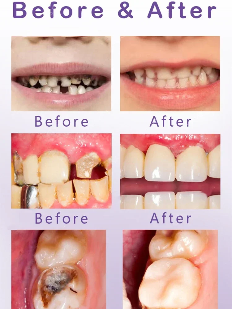 Reparação De Restauração Dente Funerais, Toda A Cavidade Dente, Proteger O Clareamento Dos Dentes, Correção De Cor