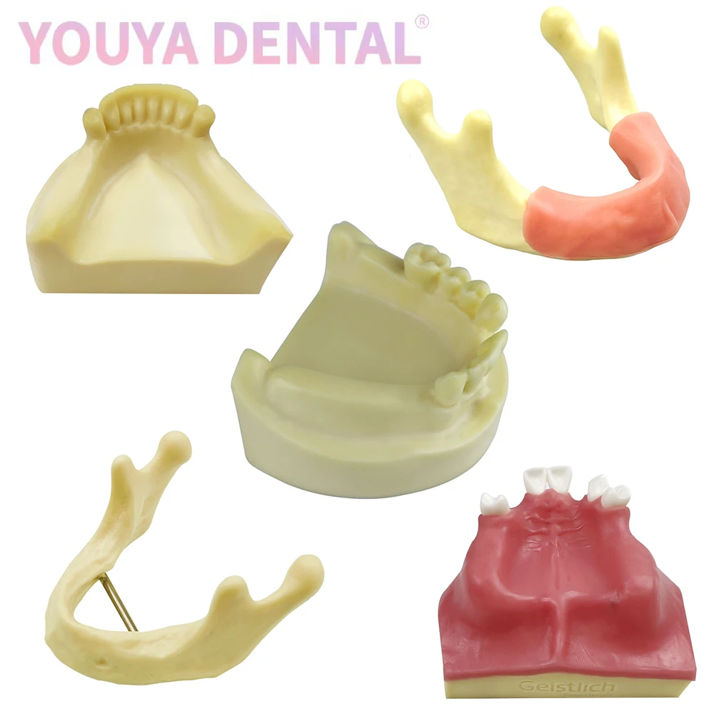 Dental Implant Practice Model Maxillary Mandibular Basic Implant Training Model With Soft Gums Suitable For Students To Practice