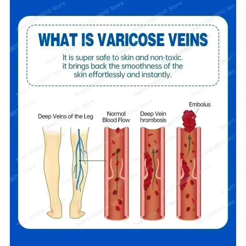 New Original Vasculitis Blood Circulation Varicose Veins Treatment New Cream 20g