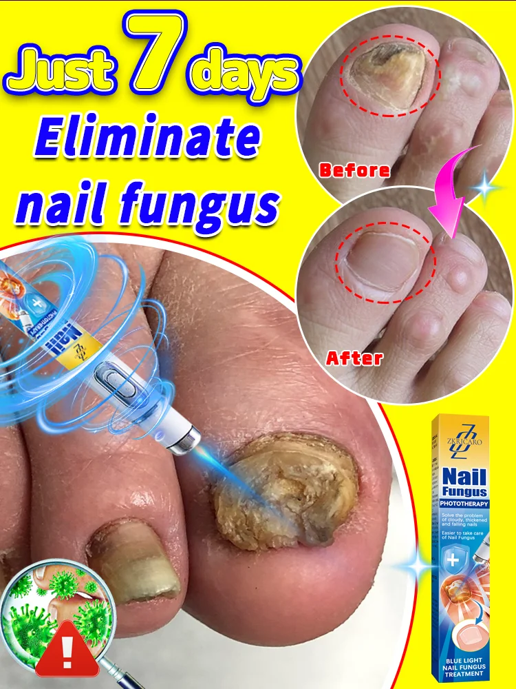 Easily solve nail fungus problems with laser treatment, the best solution for fungal nails.
