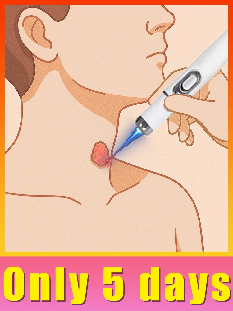 

Suitable for all types of warts, both men and women.