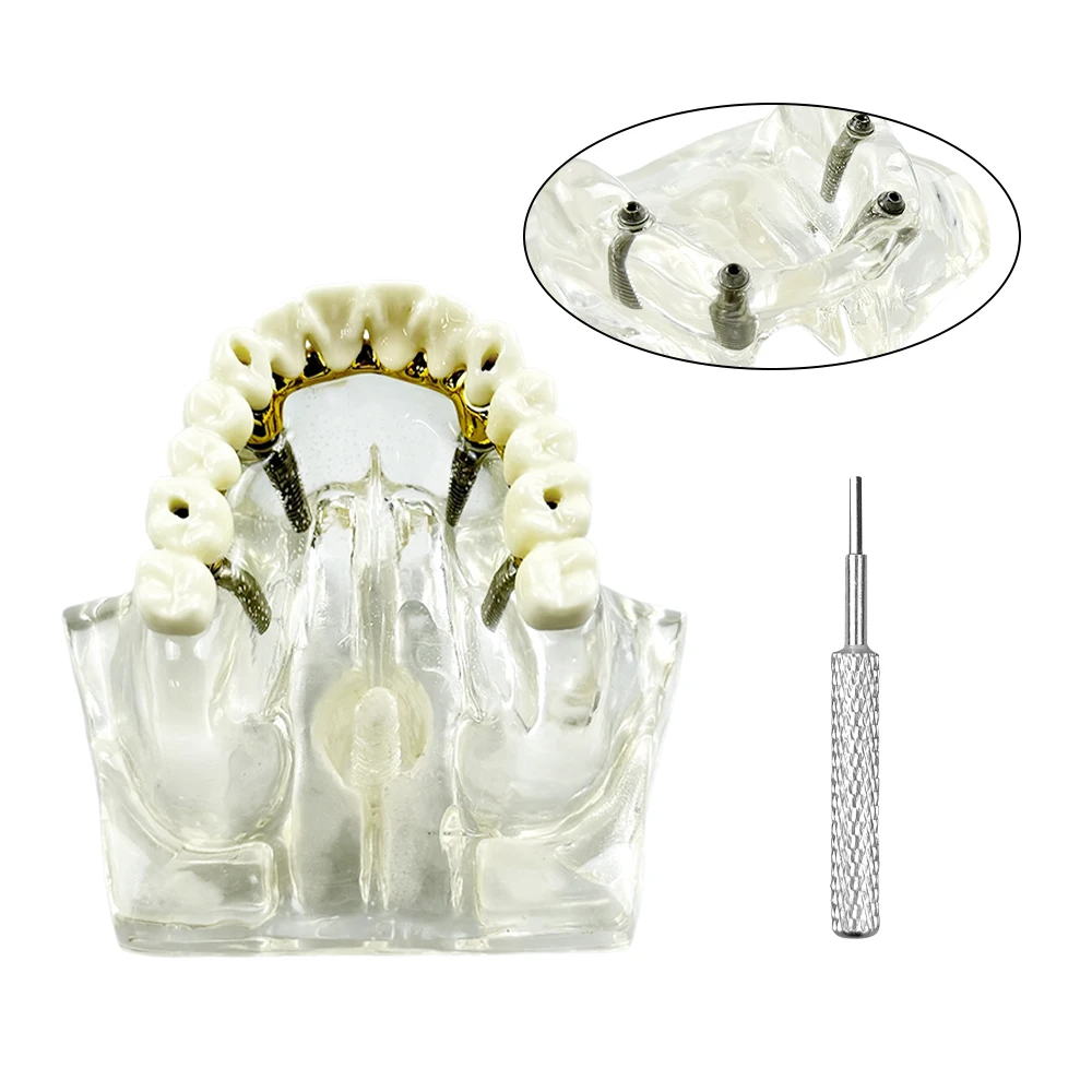 4/6 Implants Upper/Lower Jaw Dental Implant Model Transparent Dental Restoration Model Removable Overdenture Teaching  Model