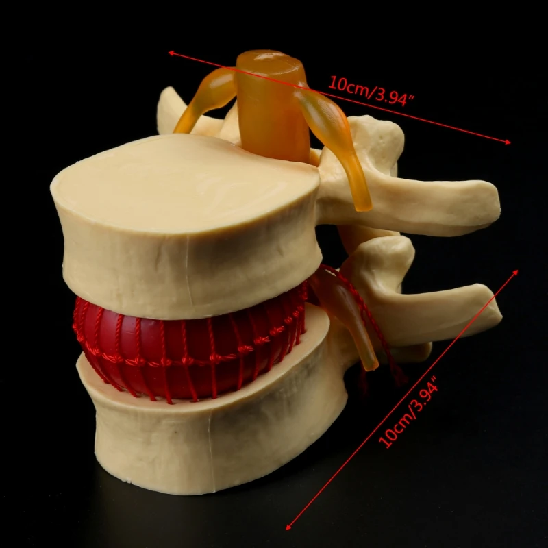 Modelo de enseñanza de hernia Lumbar, Anatomía Humana, esqueleto, columna vertebral, vértebra, modelo de demostración de Patología