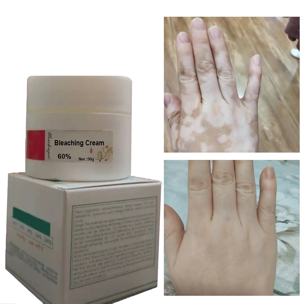 

Whitening Skin 40%, 50%, 60%, MNB Bleaching Cream Clears Blemishes Age Spots Fades Skin Tone Remove Melanin Brightening Skin