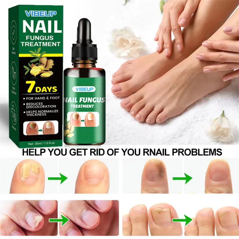 7 Dagen Nagel Schimmel Behandeling Serum Gember Anti-infectieuze Paronychia Onychomycose Teen Voet Nagel Schimmel Reparatie Gel Hand Voetverzorging