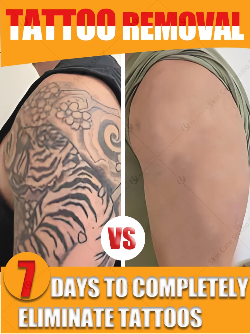 

Visibly lightens tattoos without damaging the dermis, safe and gentle