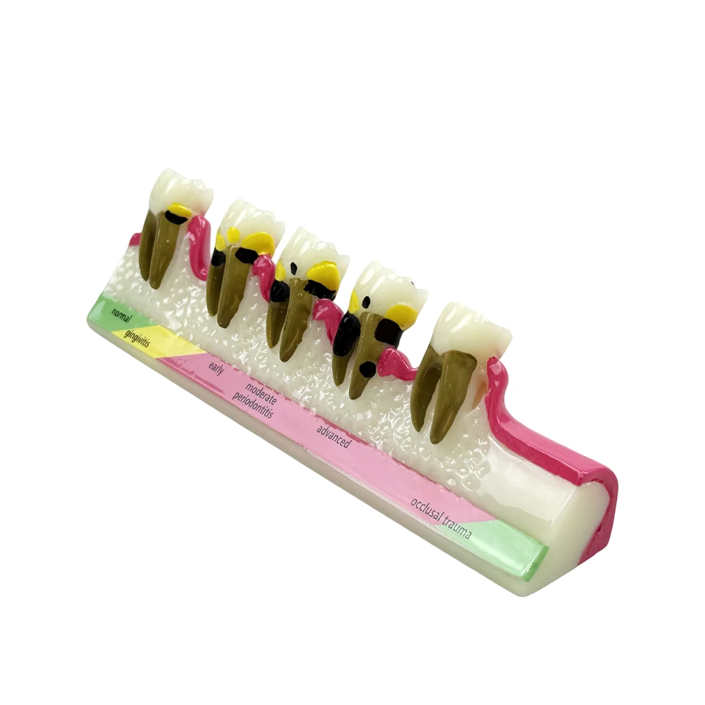 

Стоматологическая модель заболеваний пародонта Демонстрационная заболевающая пародонта Кариес Приодонтит Прогрессия Сценическая модель Стоматологическая модель