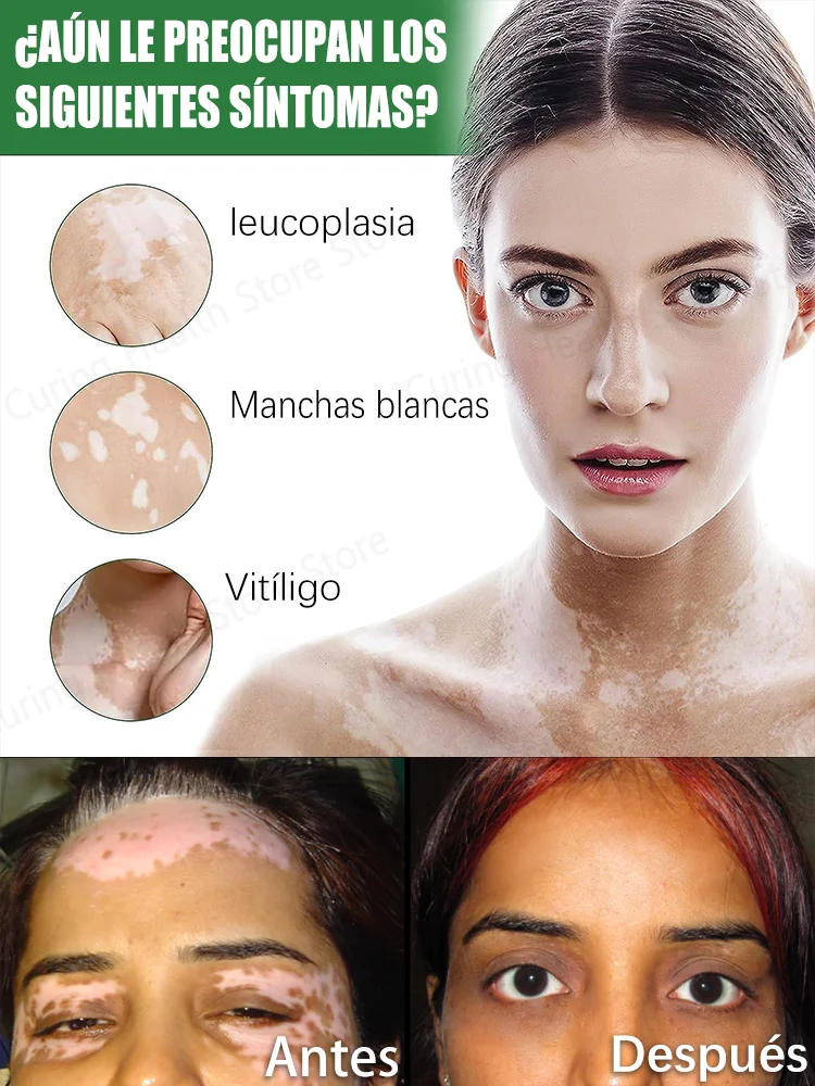 laser vitiligo